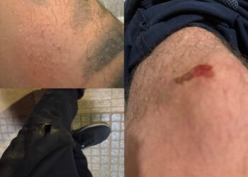 Αλεξανδρούπολη: Όταν τα αδέσποτα γίνονται απειλή – Πατέρας καταγγέλλει επίθεση σε ίδιο και παιδί