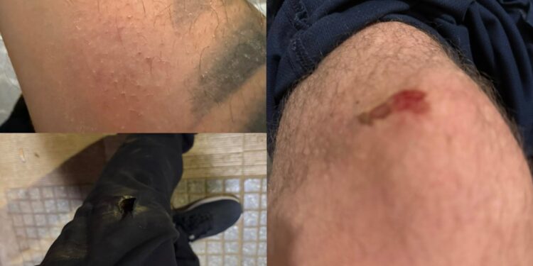 Αλεξανδρούπολη: Όταν τα αδέσποτα γίνονται απειλή – Πατέρας καταγγέλλει επίθεση σε ίδιο και παιδί